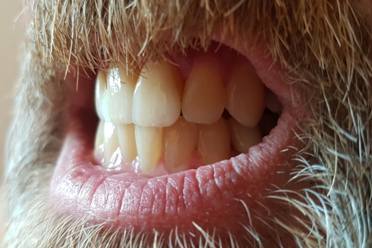 helle Frontzahnkronen natürliche Zähne Zirkon