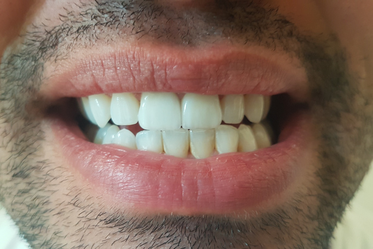 Weiße Zähne helle Zähne Schneidezähne Zirkonkronen